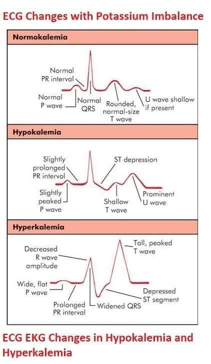 ECG ON : #HYPERKALEMIA... - VJ nursing academy