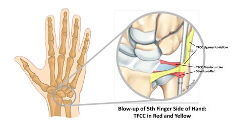 TFCC Surgery Issues and Jennifer's Story - Regenexx