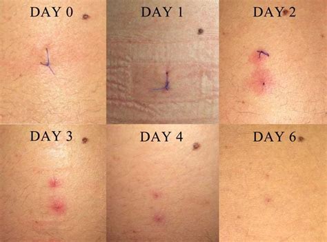 Patch testing to Vicryl sutures, daily chronological sequence of... | Download Scientific Diagram