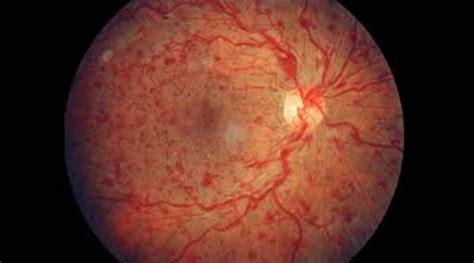 Retinal Vein Occlusion: Symptoms, Treatment and Prevention