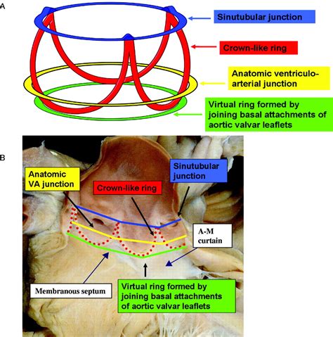 Implications Of Aortic Valve Calcification And Conduc - vrogue.co