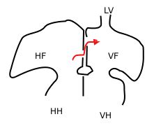 Foramen ovale (heart) - wikidoc