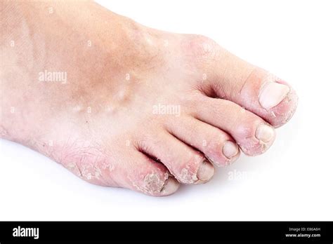 Dermatitis On Feet