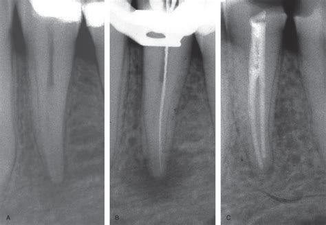 Apical Periodontitis Radiograph