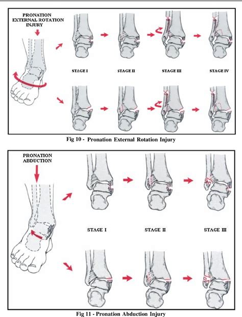 [PDF] Functional Outcome of Bimalleolar Ankle Fractures Treated With ...