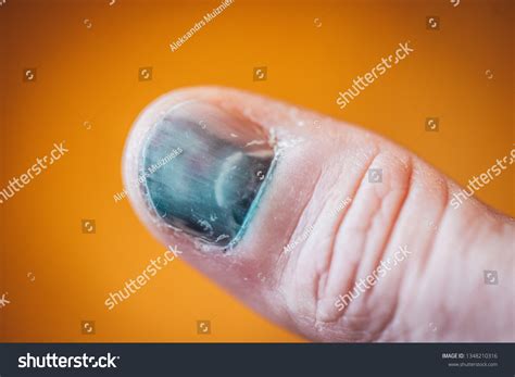 Man Hands Bruised Thumb Finger Subungual Stock Photo 1348210316 | Shutterstock