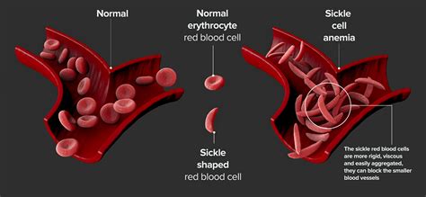 Sickle Cell Disease Histology - Rare Disease Advisor