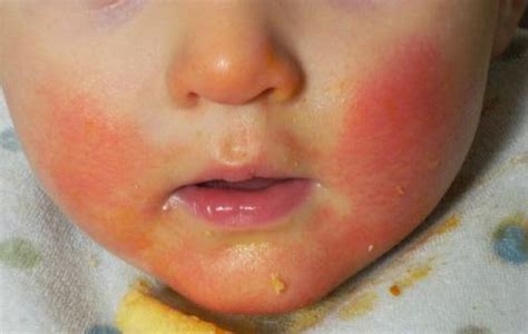 Teething Rash - Pictures, Causes, Treatment