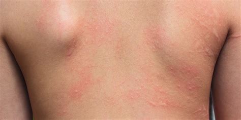 Allergic Contact Dermatitis Treatment | Norris Dermatology Portland OR