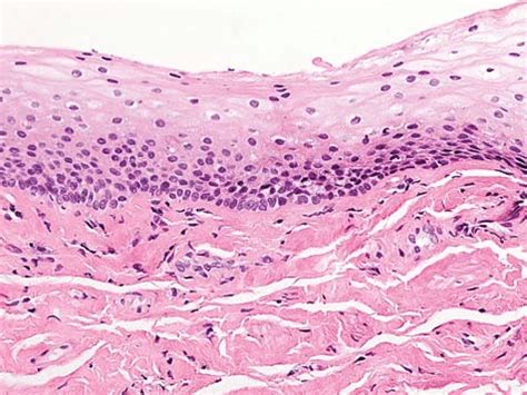 Scar: squamous mucosa with stromal fibrosis and absent infiltrate (H&E... | Download Scientific ...