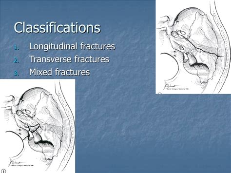 PPT - Fracture of temporal bone PowerPoint Presentation, free download ...