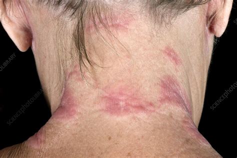 Eczema on the neck - Stock Image - C046/1000 - Science Photo Library