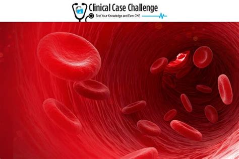 PRIME® Making a Diagnosis of Myelodysplastic Syndromes in Adults With ...