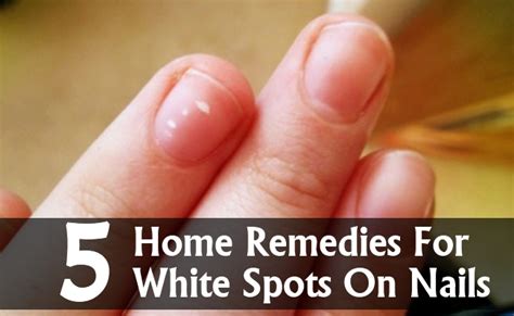 5 Amazing Home Remedies For White Spots On Nails | Search Herbal & Home Remedy