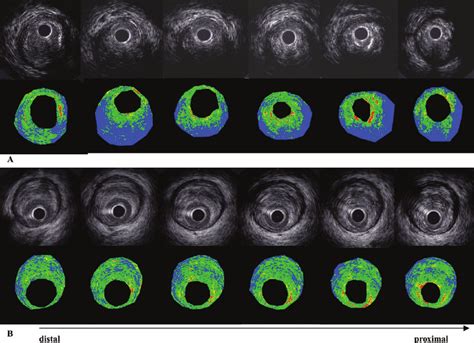 Representative images of serial conventional intravascular ultrasound... | Download Scientific ...