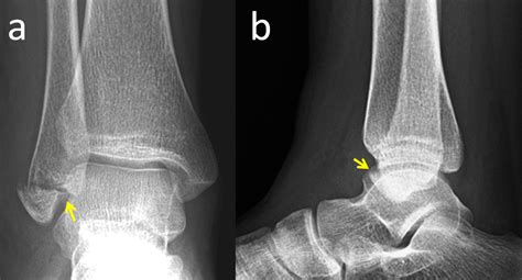 Cureus | Isolated Lateral Malleolar Fracture Treated with a ...