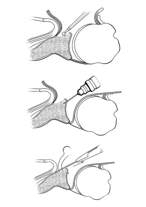 Glenoid Cavity Shoulder Surgery Photograph by Maurizio De Angelis ...