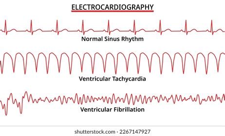 1,152 Ventricular Tachycardia Images, Stock Photos, 3D objects, & Vectors | Shutterstock