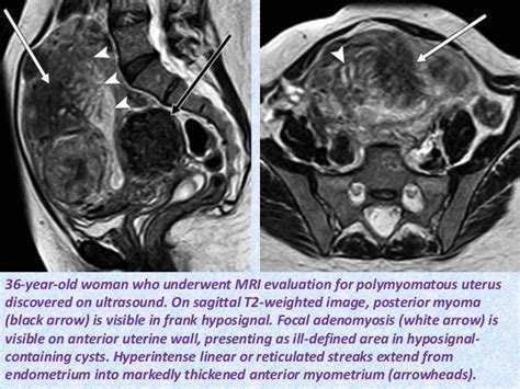 Presentation1.pptx, radiological imaging of endometriosis.