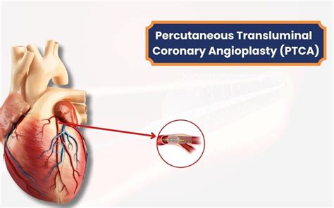 Percutaneous Transluminal Coronary Angioplasty (PTCA): A Vital Lifesaving Procedure for Heart ...