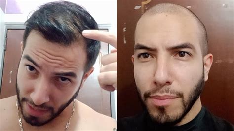 COMB OVER vs BUZZ CUT TRANSFORMATION for Balding Man - YouTube