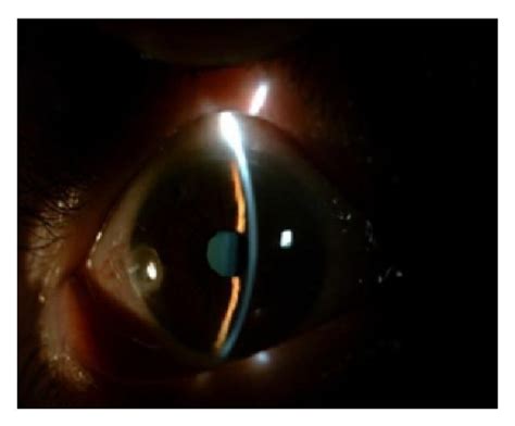 Ciliar injection in the conjunctiva (a), closure of iridocorneal angle... | Download Scientific ...