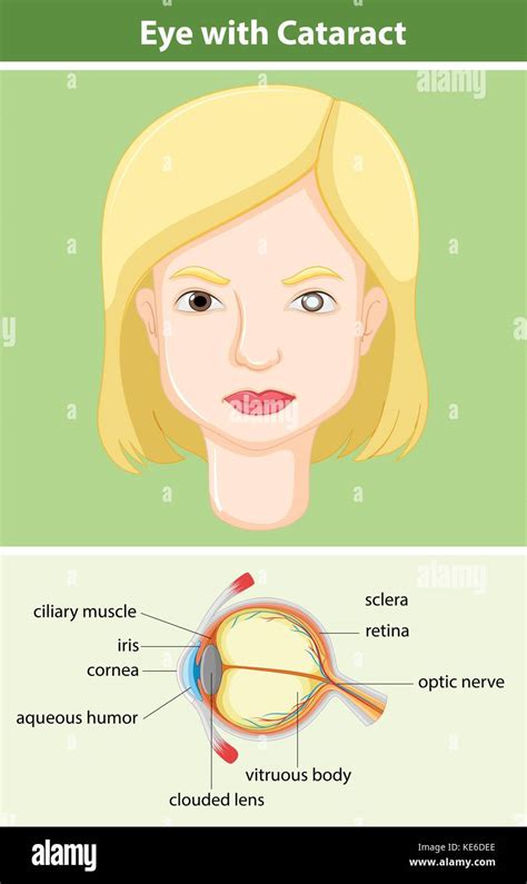 Diagram showing eye with cataract illustration Stock Vector Image & Art - Alamy