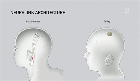 Elon Musk unveils brain chip implant: 'It's like a Fitbit in your skull ...