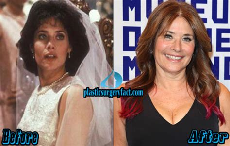 Lorraine Bracco Plastic Surgery Before and After