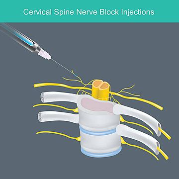 Illustration Of Cervical Spine Nerve Block Injections With Anesthetic Solution Vector, Health ...