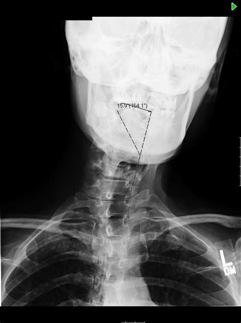 54 yo woman with neuromuscular condition and cervical scoliosis measuring 16 degrees and ...