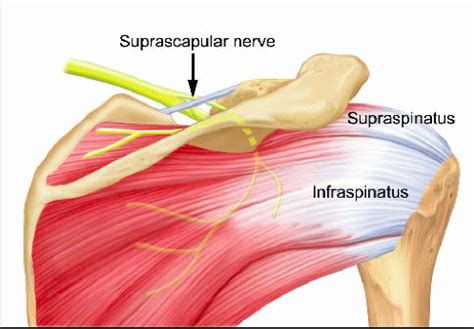 Supraspinatus Impingement and Shoulder Pain - Locomotion Therapy