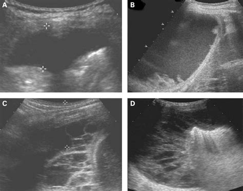 Ultrasound staging of empyema. (A) Grade 1 effusion showing anechoic... | Download Scientific ...