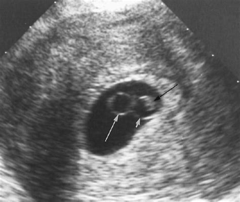 Obstetric Ultrasound First Trimester | Radiology Key