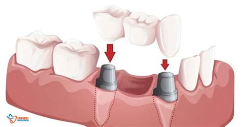 A Full Guide to Dental Bridge + Before and After Work Photos - Enhance ...