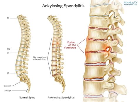 Found on Google from rehabmypatient.com | Ankylosing spondylitis, Vertebrae