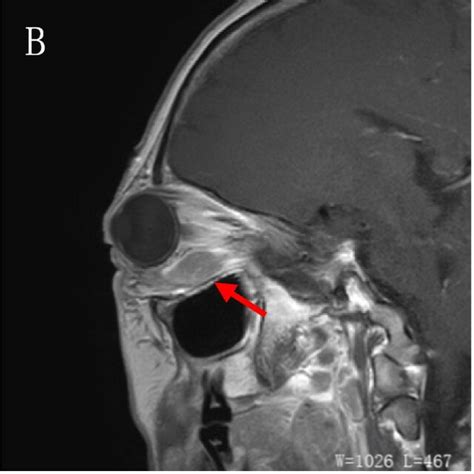 Magnetic resonance imaging of the right inferior rectus muscle ...