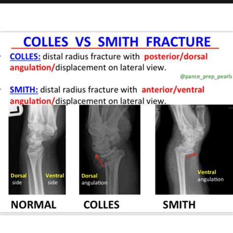 Smith Vs Colles Fracture