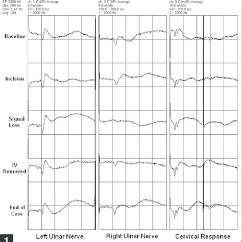 Somatosensory-evoked potentials signals monitoring showing loss of ...