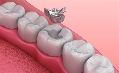 Mercury Filling Removal - Birmingham, AL - Gooch Family Dental