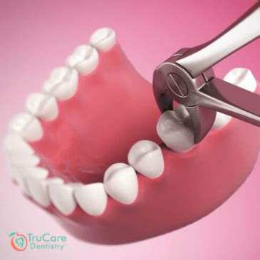 complications in tooth extraction – TruCare Dentistry Roswell