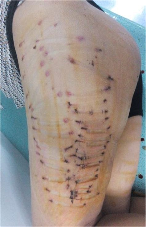 A Novel Surgical Technique for treatment of Morel-Lavallée Lesion: Endoscopic debridement ...