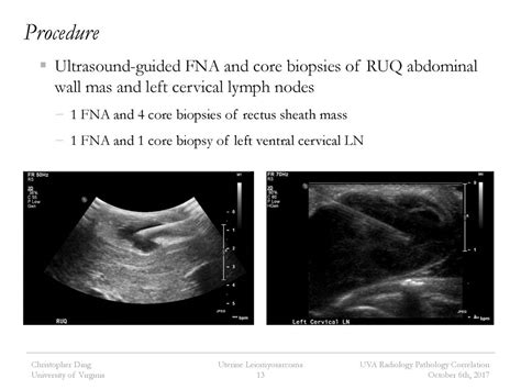 Uterine Leiomyosarcoma - ppt download