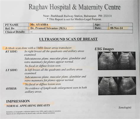 Fibroadenoma of Breast Cured by Homeopathy | Case Study