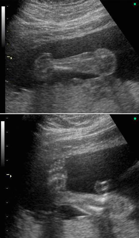 Ultrasound scan showing talipes equinovarus. | Download Scientific Diagram