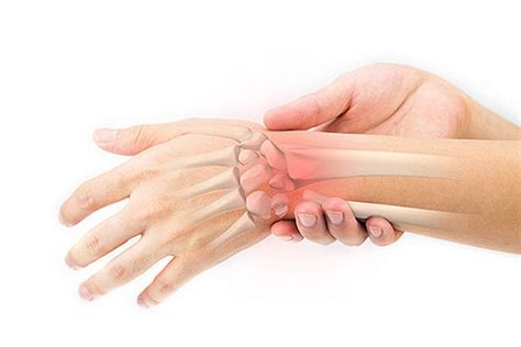 What Is a Sprained Wrist? - WristSupports.co.uk