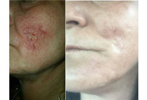 Help Treat Demodex Mites | Hair loss, Acne | Ungex Products