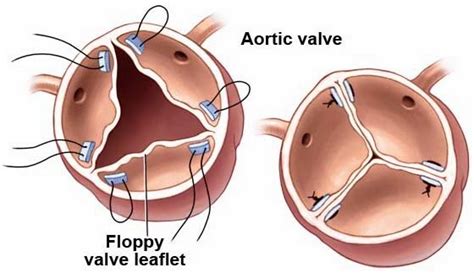 Heart-symptoms: Aortic Valve Repair, Replacement and Surgery