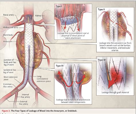 Figure 1 from Endovascular repair of abdominal aortic aneurysm. | Semantic Scholar