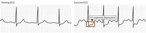 Angina | Cardiac College